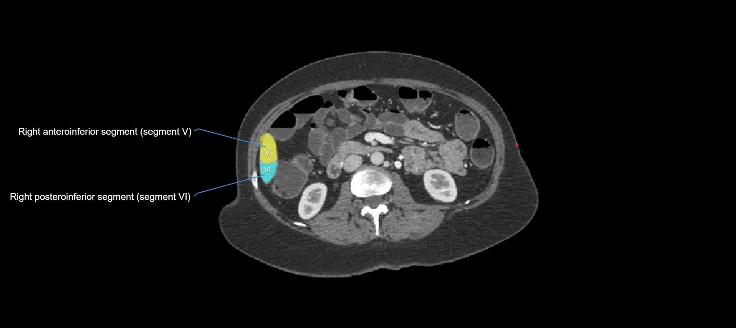 CT liver segments axial cross sectional anatomy labelled image-00008.webp